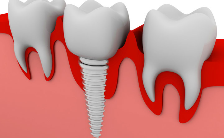 denti fissi